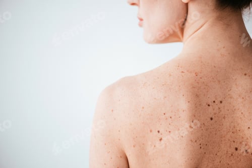 Preview: cropped view of naked woman with skin sickness on white