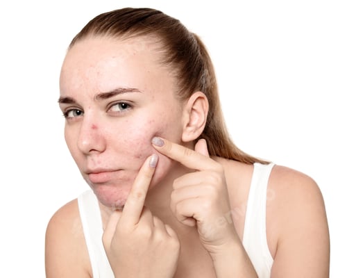 Preview: Young woman with acne problem on white background