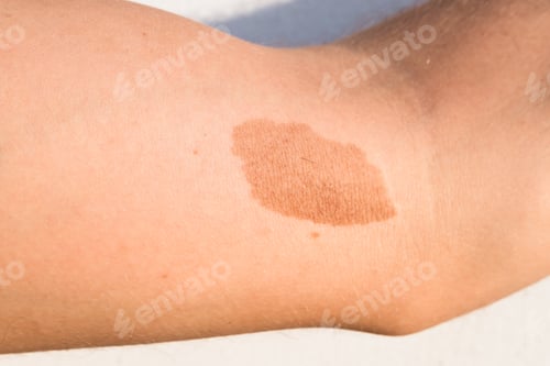 Preview: A large mole, birthmark on the skin of the arm of a young man.