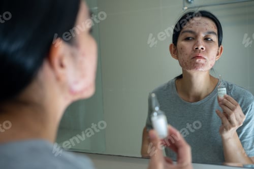 Preview: Acne on face because the disorders of sebaceous glands productions. Acne or a Cosmetic