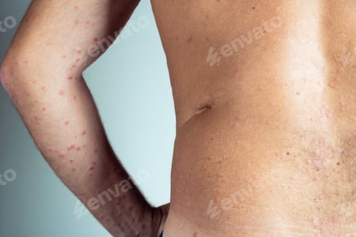 Preview: Back view of bare elbow and back of unrecognizable man showing inflamed skin with blemishes sufferin