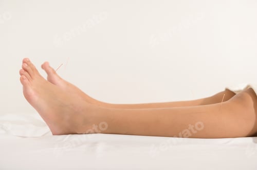 Preview: Woman Received acupuncture treatment on leg