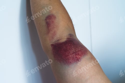 Preview: Bicep tear or strain, tendon injuries on a muscular man hand. Trauman or trauma injury. Health and m