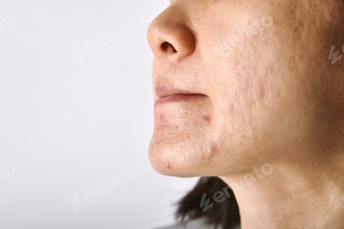 Preview: Skin problem with acne diseases