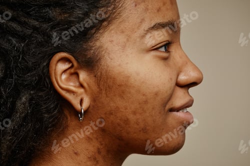 Preview: Profile ethnic young woman smiling with acne scars on face and ear piercings