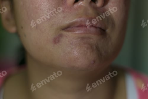 Vista previa: Asian girl having skin problem with face ance