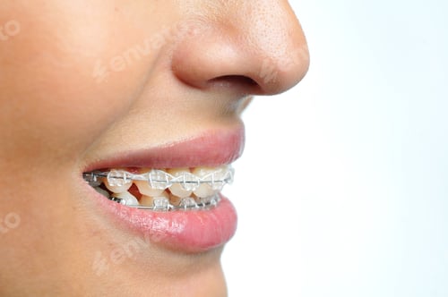 Preview: Close-up of ceramic and metallic braces on teeth. Orthodontic Treatment. Dental Care