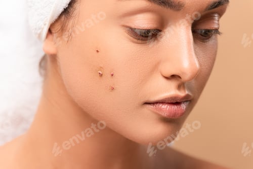 Preview: close up of young woman with pimples on face isolated on beige