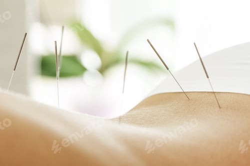 Preview: Female back with steel needles during procedure of acupuncture therapy