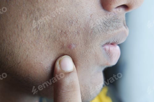 Preview: close up of young man face with skin problem .