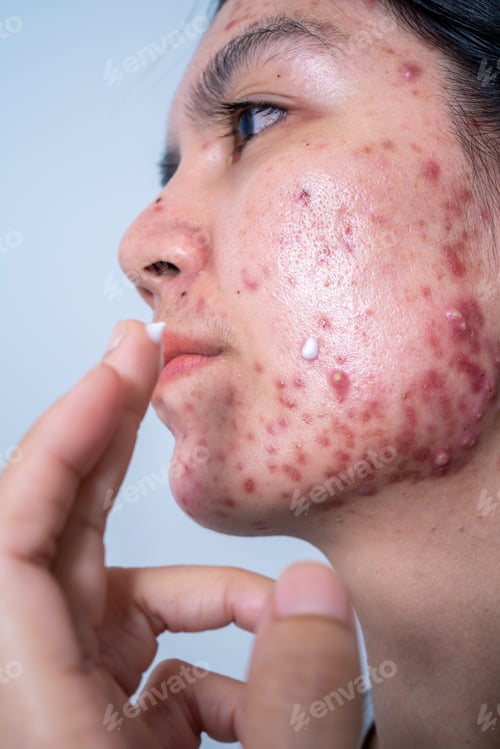 Preview: Acne on face because the disorders of sebaceous glands productions. Acne or a Cosmetic