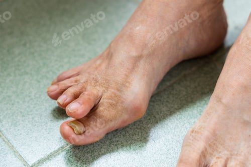 Preview: Asian woman suffer from serous Hallux Valgus over the feet toe
