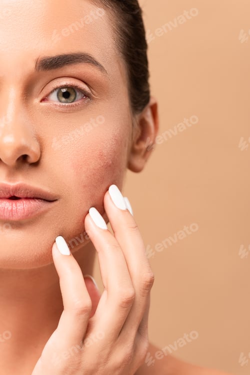 Preview: cropped view of girl touching face with problem skin and looking at camera isolated on beige