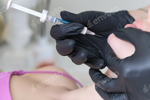 Preview: detailed view of a hyaluronic acid injection procedure, focusing on the chin area. experiences or