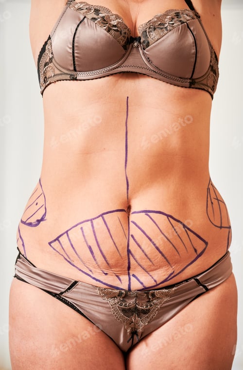 Vista previa: Woman body with marks for plastic surgery.