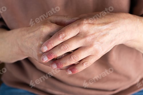 Preview: Woman hands with atopic dermatitis, eczema, allergy reaction on skin