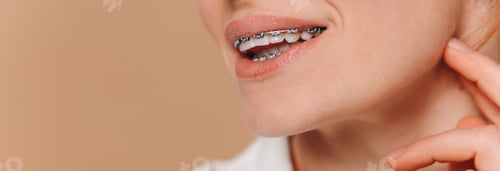 Preview: Close-up of a woman with braces on a beige background