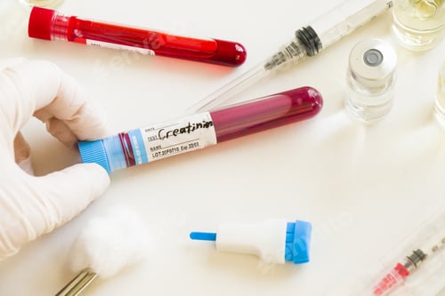 Preview: Closeup shot of a gloved hand holding a creatinine blood test sample in a lab