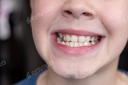 Preview: Child's crooked teeth. Young man showing crooked growing teeth.