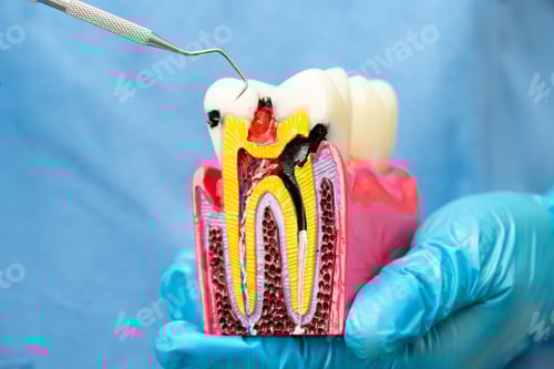Preview: Asian dentist holding dental implant, artificial tooth roots into jaw, root canal