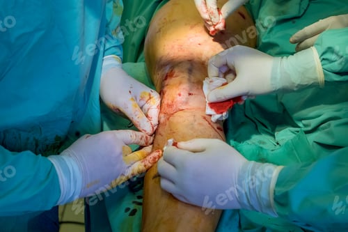 Preview: Orthopedic surgeons perform surgeries on leg to treat patient sustained injuries.