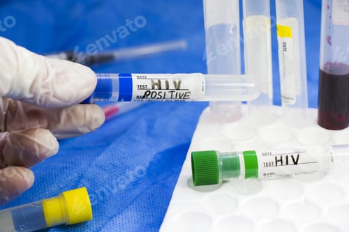 Preview: Hand in glove holding positive HIV blood specimen on test tube in the laboratory
