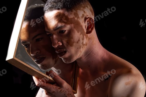 Preview: Vitiligo, beauty and mirror for man reflection of skin condition, disorder or problem with dermatol