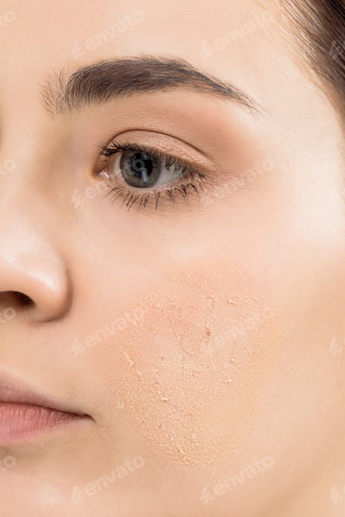 Preview: cropped view of young woman with problem skin