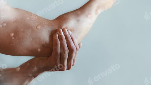 Preview: Male arm affected by blistering rash because of monkeypox or other viral infection on grey