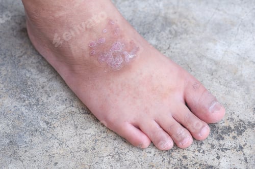 Preview: Scars on the skin of a man's feet are inflamed due to a fungal infection.