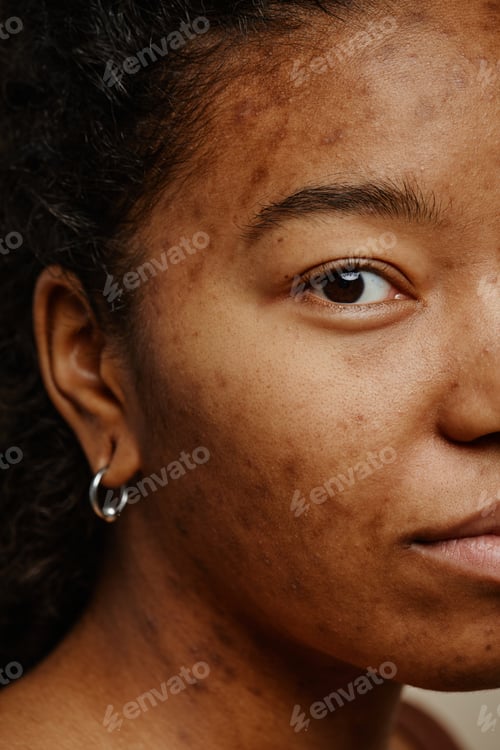Preview: Macro shot of acne scars on face of young black woman looking at camera