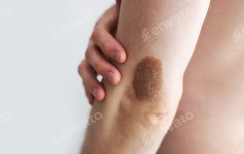 Preview: Large hairy nevus on arm about elbow of man, space for text