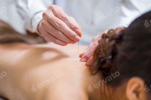 Preview: Young woman receiving acupuncture
