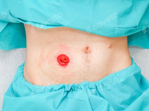 Preview: A young patient in pajamas with an open stomach, postoperative scars and a clean intestine out..