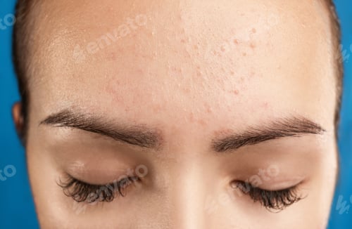 Preview: Teenage girl with acne problem on blue background, closeup