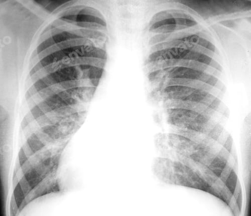 Preview: Chest X-ray