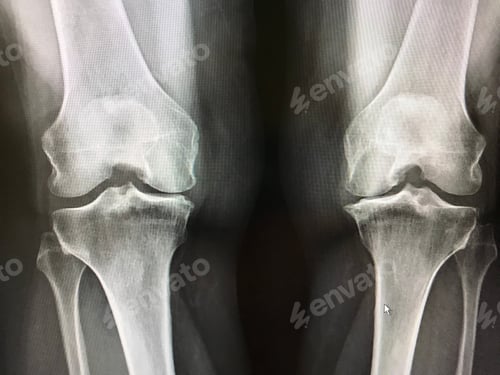 Preview: Xray shows narrowing of bones at the knees, cartilage loss, Spurs and calluses with osteoarthritis