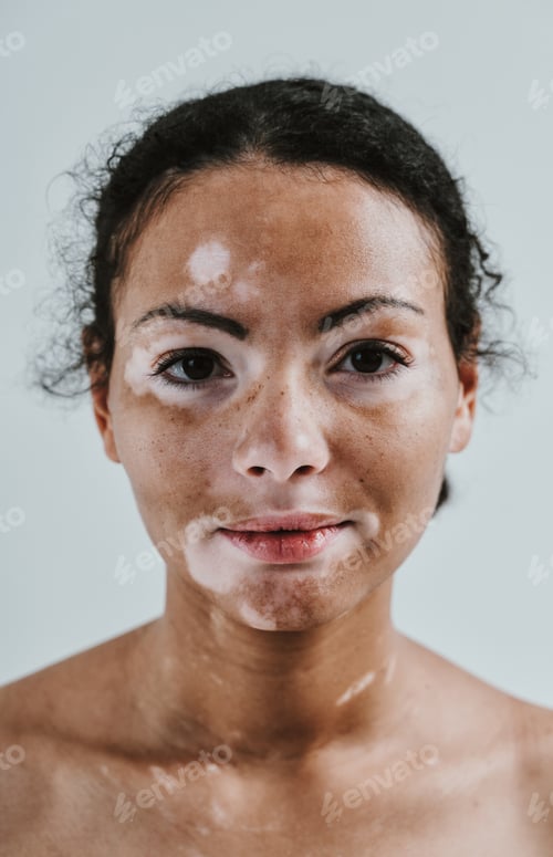 Preview: Beautiful woman with vitiligo skin