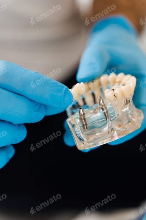 Preview: Close-up of artificial jaw with dental implants during prosthetics consultation