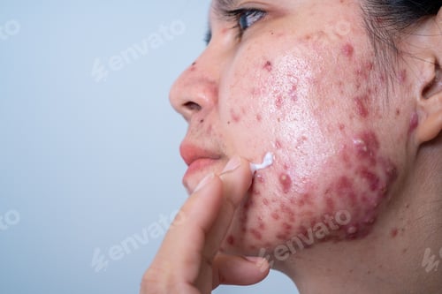 Preview: Acne on face because the disorders of sebaceous glands productions. Acne or a Cosmetic