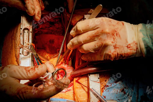 Preview: Patient during surgical procedure at open heart in operation a room