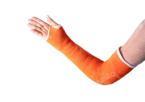 Preview: hand in an orange fiberglass cast after a fracture of the wrist bones for fixation on a white