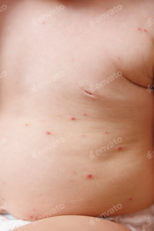 Preview: Detail of baby's skin covered with chickenpox blisters