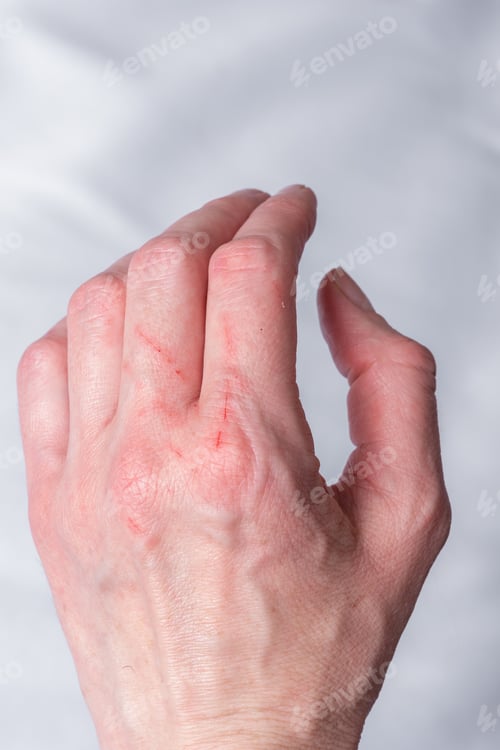Preview: Skin condition after a cat scratch and bite. A hand scratched by a curious little kitten, a cat