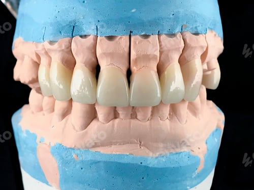 Preview: Dental porcelain prosthesis implant tooth in dental laboratory. Front view