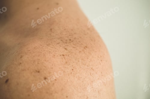 Preview: Skin on a man back with scattered moles