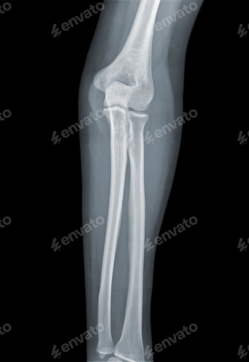 Preview: Elbow X-ray negative