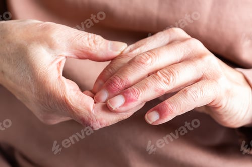 Preview: Woman hands with atopic dermatitis, eczema, allergy reaction on skin