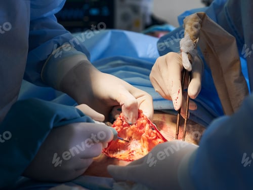 Preview: Doctors performing abdominoplasty surgery in operating room.