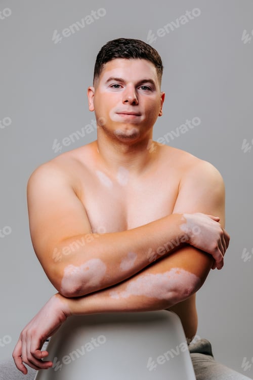 Preview: Vitiligo young man naked torso in the studio sitting on a chair looking at the camera.